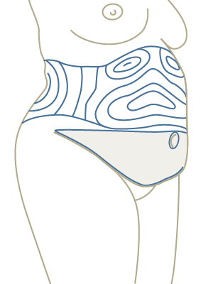 Bauchstraffung mit Liposuction Fettabsaugung Verlauf OP