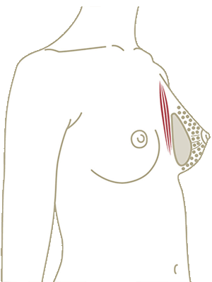 Brustvergrösserung über dem Brustmuskel