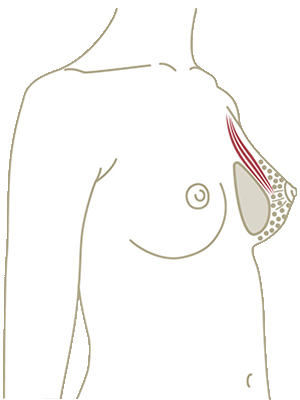 Brustvergrösserung unter dem Brustmuskel