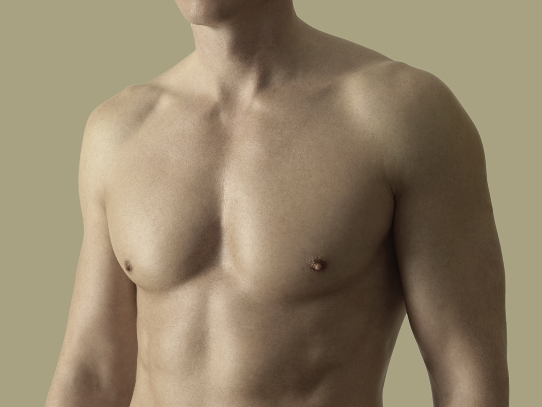 Breast reduction in gynecomastia