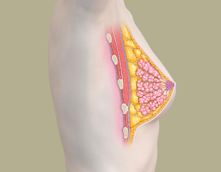 brust nach Korrektur einer Fehlbildung - anatomische Darstellung
