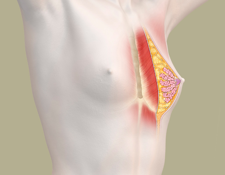 Symmetrische Brust nach Korrektur einer Brustfehlbildung - anatomische Darstellung
