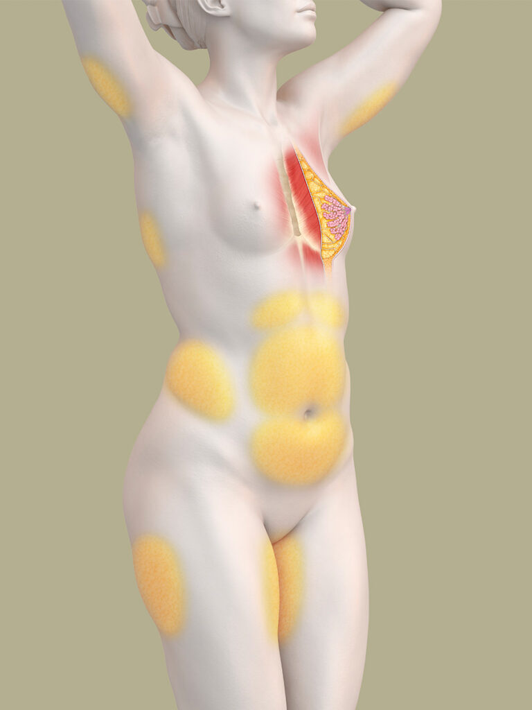 Brustaufbau einer fehlgebildeten Brust durch Eigenfett - anatomische Darstellung