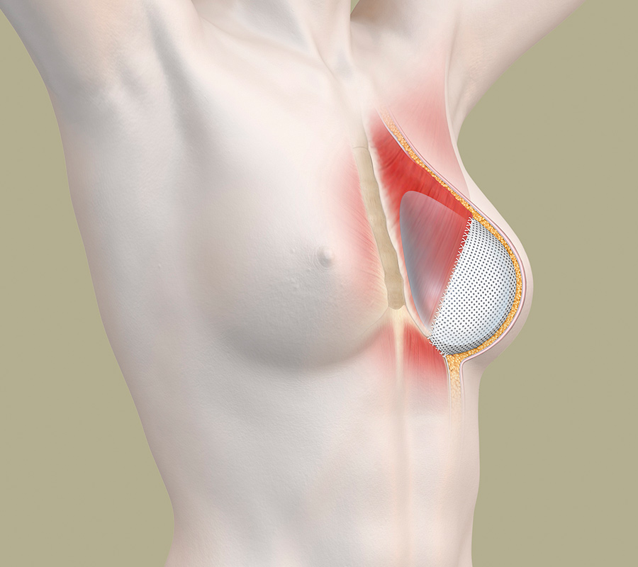 Brustaufbau mit Silikonimplantat und Gewebematrix/Netz - anatomische Darstellung