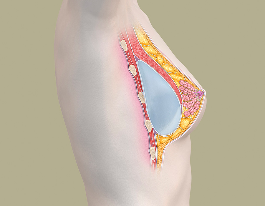 Brustaufbau mit anatomischen Implantaten zur Korrektur einer Brustfehlbildung - anatomische Darstellung
