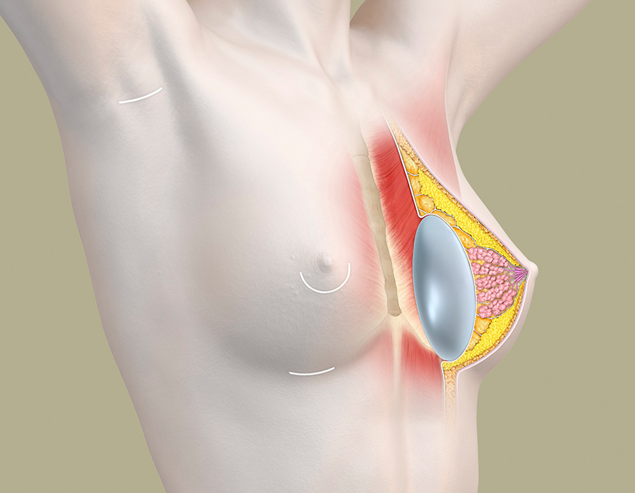 Hybrid-Brustaufbau zur Korrektur einer Brustfehlbildung - anatomische Darstellung