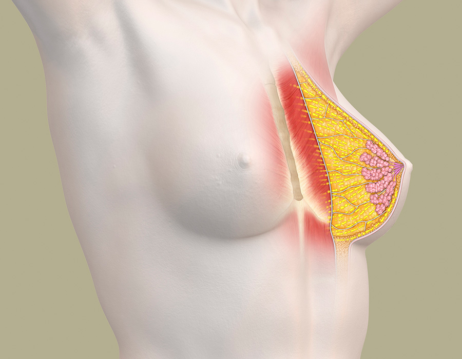Brustaufbau mit Lipofilling zur Korrektur von Brustfehlbildungen - anatomische Darstellung