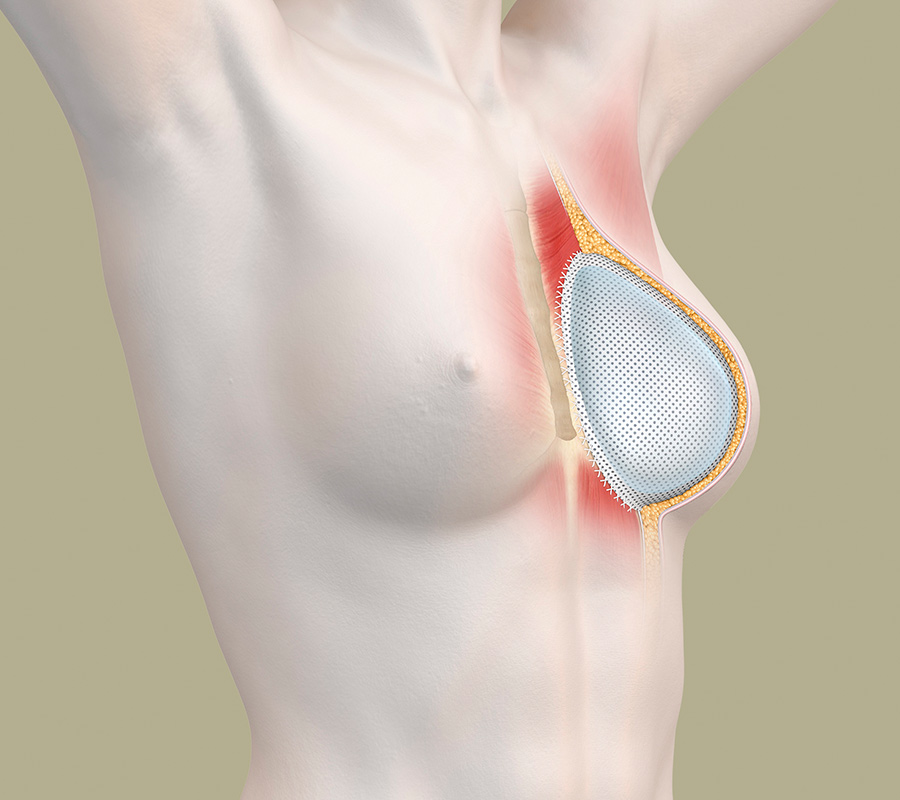 Brustrekonstruktion mit Gewebematrix - anatomische Darstellung