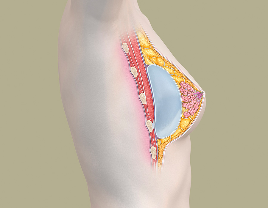 Brustaufbau mit rundem Implantat zur Korrektur einer Brustfehlbildung - anatomische Darstellung