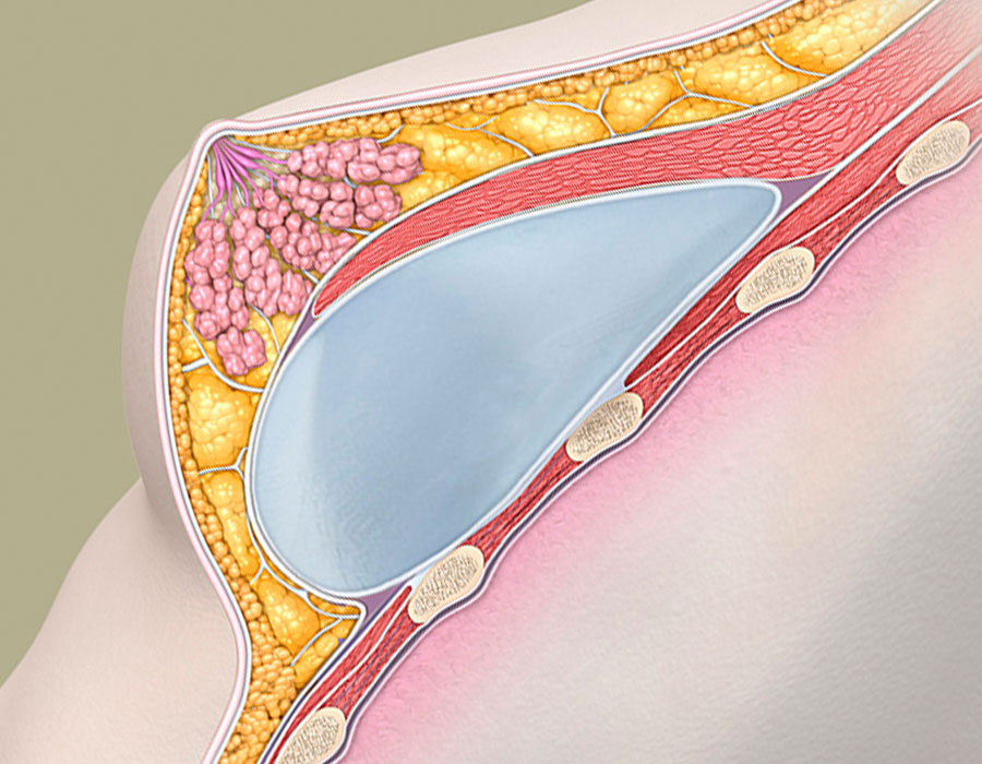 Anatomisches Brustimplantat im Querschnitt für eine Brustvergrösserung mit natürlicher Form
