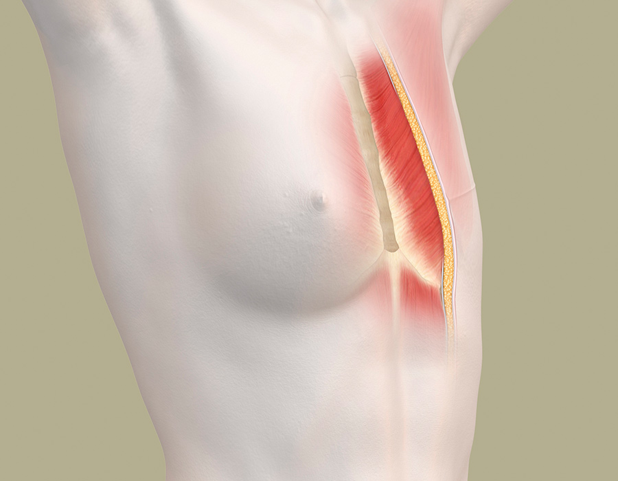 Brustfehlbildung: Brustaplasie vor einer Brust-Korrektur: anatomische Darstellung