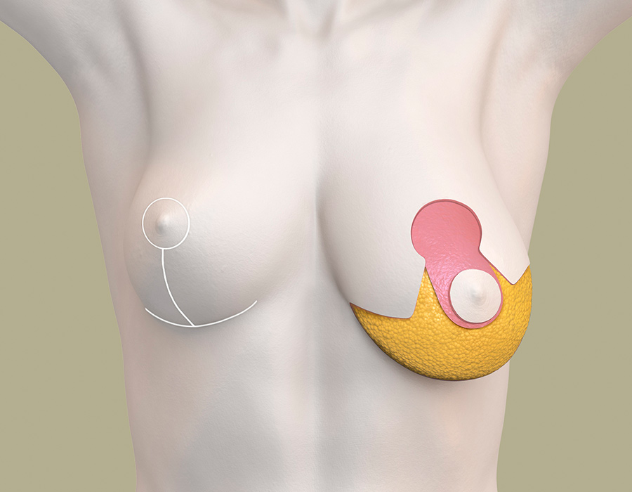 Brustverkleinerung zur Korrektur einer starken Asymmetrie - anatomische Darstellung