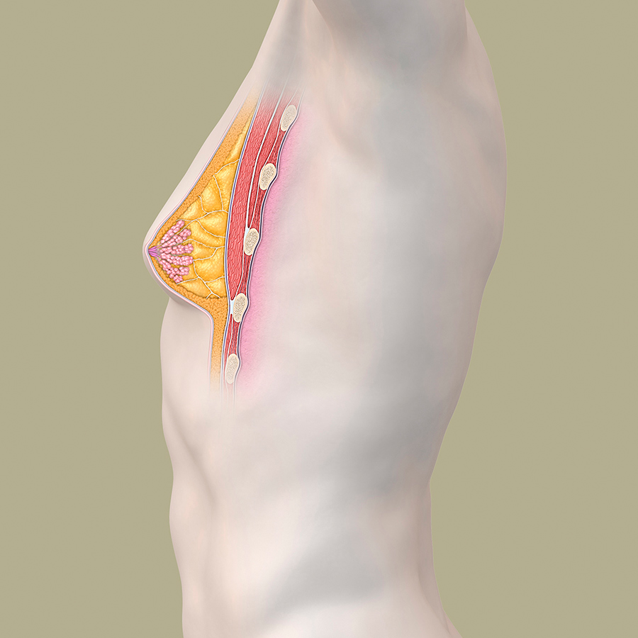 Gynäkomastie Männerbrust Fettgewebe seitlich vor OP zur Beseitigung der weiblichen Brust beim Mann durch den Arzt Illustration