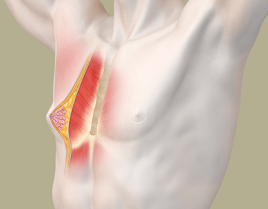 Gynäkomastie Darstellung zur ärztlichen Diagnose. Hier Fettgewebe als Männerbrust illustriert
