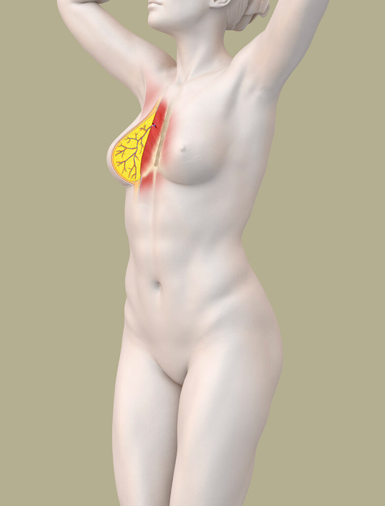 Mikrochirurgische Brustrekonstruktion mit Eigengewebe - anatomische Darstellung