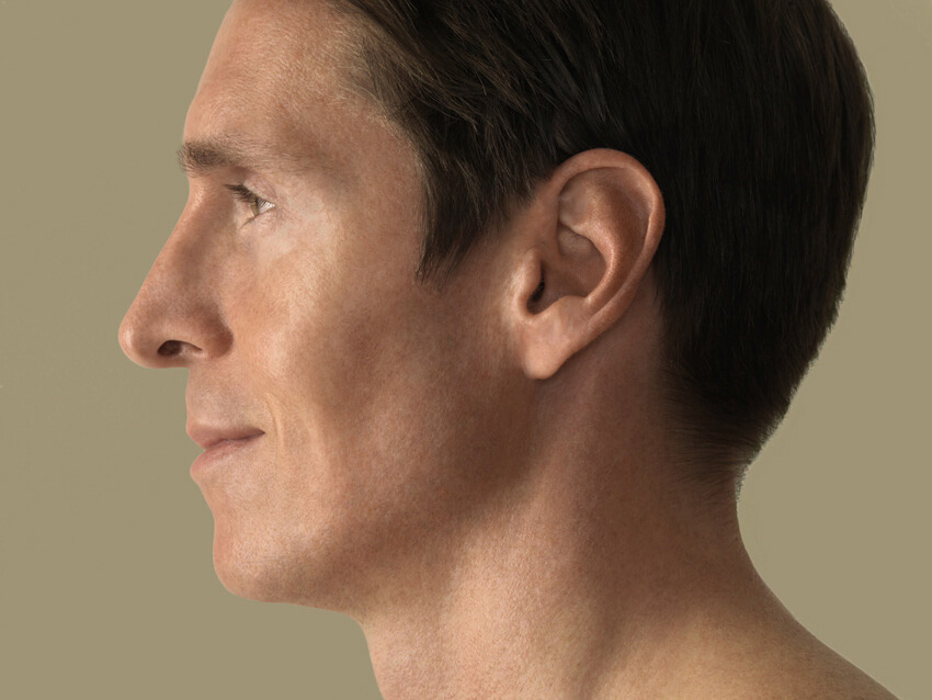 Ohrenkorrektur, Ohrenanlegeplastik (Otoplastik) Mann Ohren Bern Plastische Chirurgie