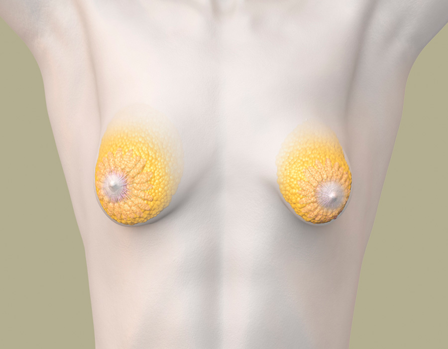 Tubulare Brust (Schlauchbrust) vor einer Brustkorrektur - anatomische Darstellung